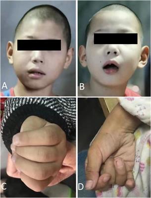 Case Report: Identification of a novel CASK missense variant in a Chinese family with MICPCH